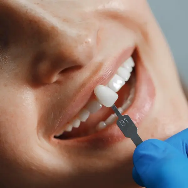 Lentes de Contato Dental